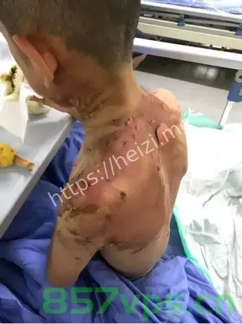 男童被沸水烫伤