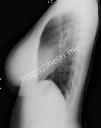 X光照片流出AV女优内幕