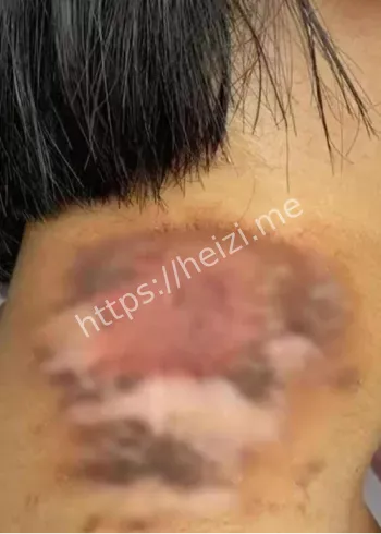 河南隐翅虫孩童溃烂