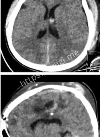 金边脑损伤医疗奇迹