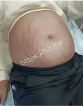 四川13岁女孩腹中3条蛇